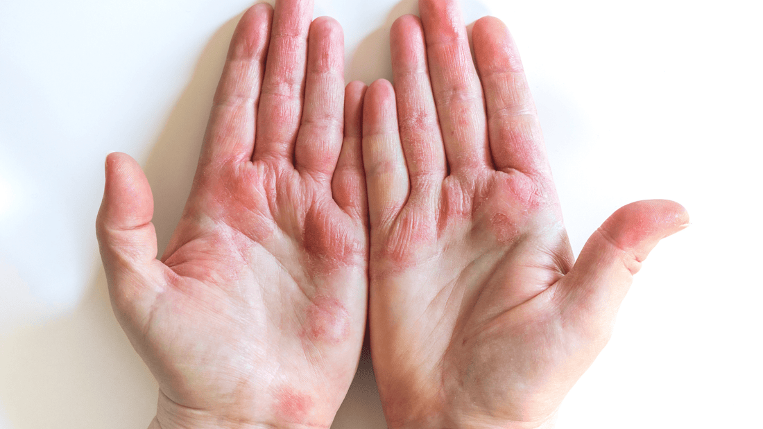 Eczema: Jamie's Story