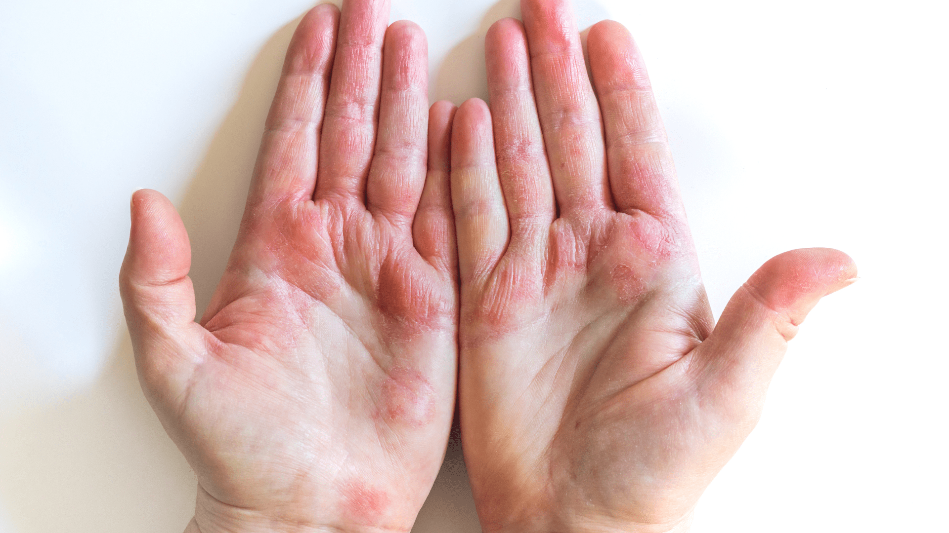 Eczema: Jamie's Story