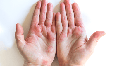 Eczema: Jamie's Story