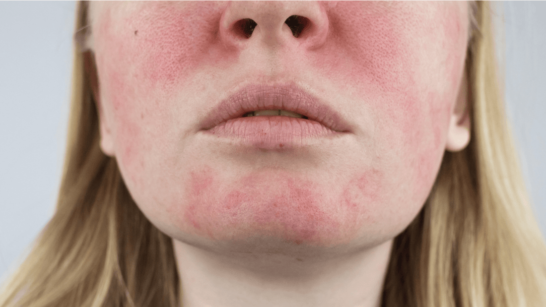 Model with Rosacea. Inlight Beauty