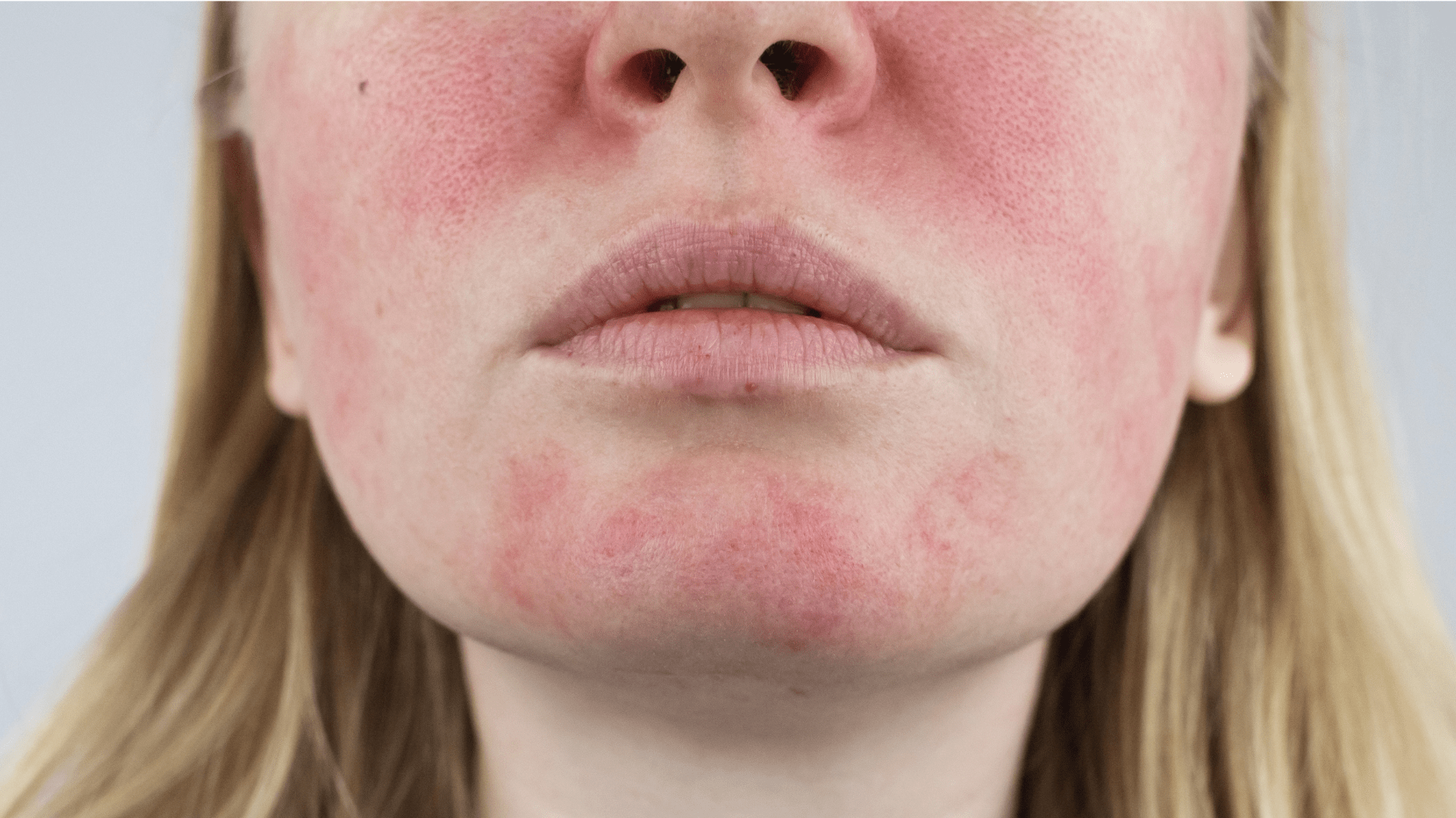 Model with Rosacea. Inlight Beauty