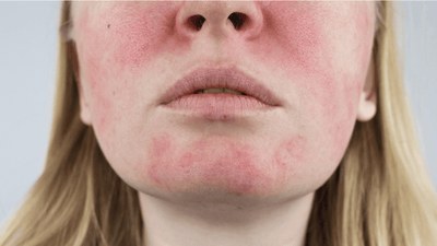 Rosacea Awareness Month